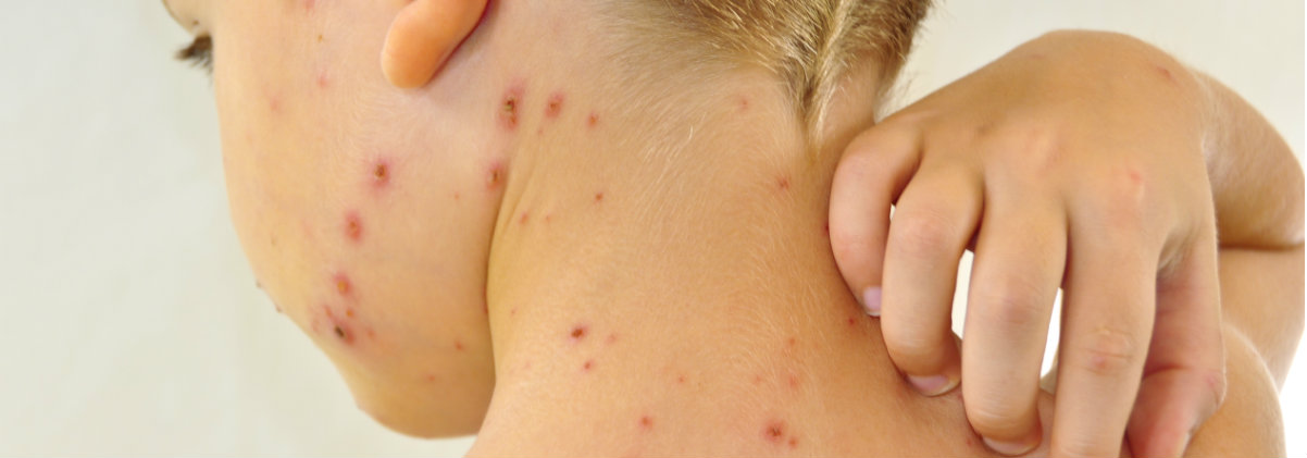 What Is Chickenpox Symptoms Treatment Canstar